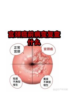 宫颈病变治好了，打算怀孕前还要再检查一遍吗？-两性知识丨两性健康--你想了解的我都知道