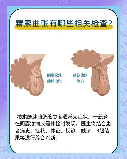 精子碎片率高和精索静脉曲张有关吗