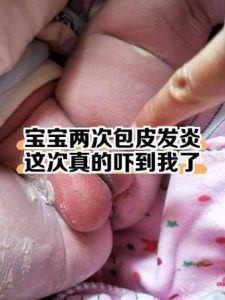 孩子包皮发炎红肿，该挂什么科？-两性知识丨两性健康--你想了解的我都知道