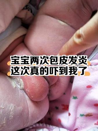 孩子包皮发炎红肿，该挂什么科