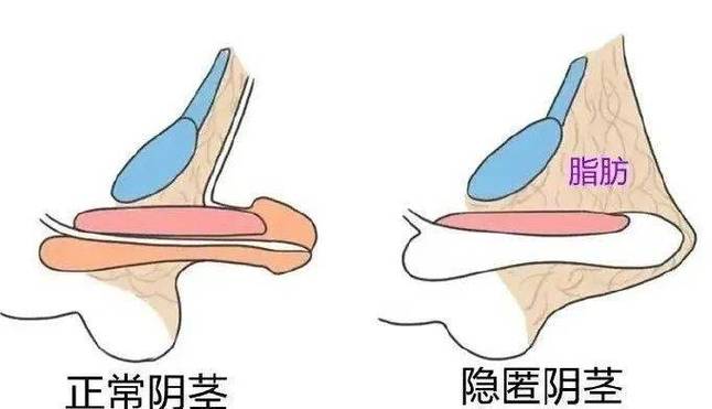 隐匿性阴茎和真性短小,家长如何区分