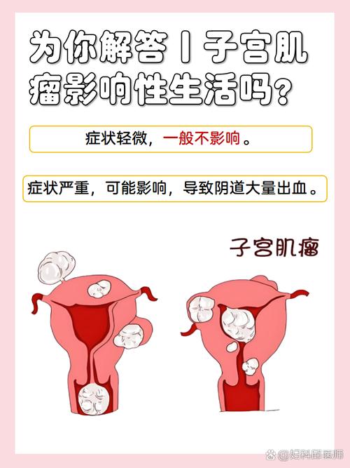子宫肌瘤会导致性欲下降吗