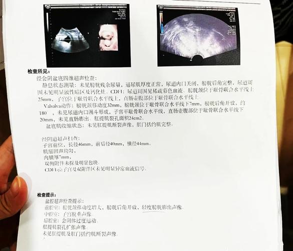产后盆底超声多久复查一次