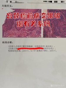 吸烟和宫颈病变有关系吗-两性知识丨两性健康--你想了解的我都知道