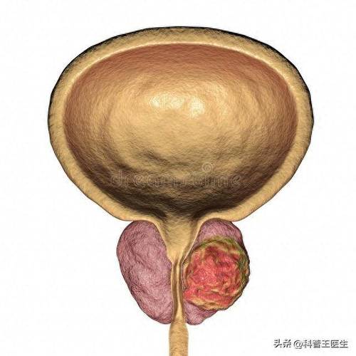 尿道口分泌物是哪种感染的表现