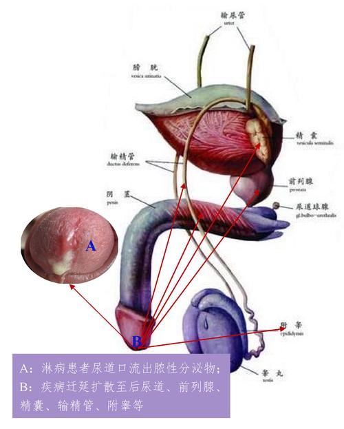 尿道口分泌物是哪种感染的表现