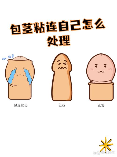 包皮龟头粘连需要处理吗