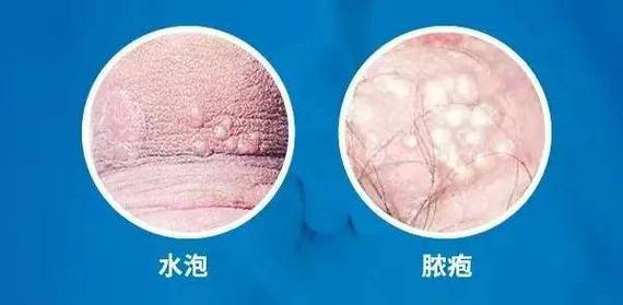 生殖器疱疹没症状时还会传染吗