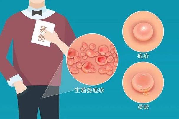 生殖器疱疹没症状时还会传染吗