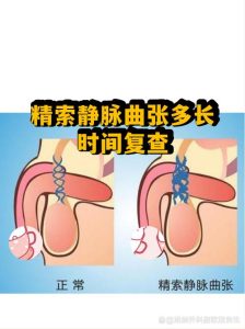 精索静脉曲张做完手术，复查到底该怎么安排？-两性知识丨两性健康--你想了解的我都知道