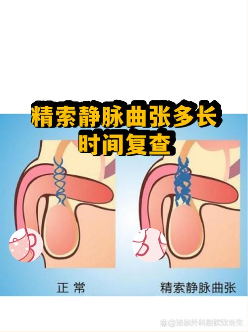 精索静脉曲张术后怎么复查