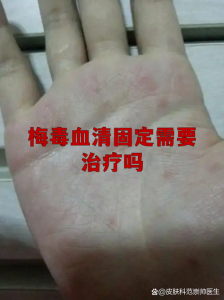 梅毒血清固定需要长期治疗吗-两性知识丨两性健康--你想了解的我都知道