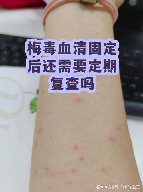 梅毒血清固定还要继续治疗吗
