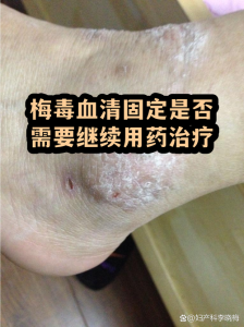 梅毒血清固定还要继续治疗吗-两性知识丨两性健康--你想了解的我都知道
