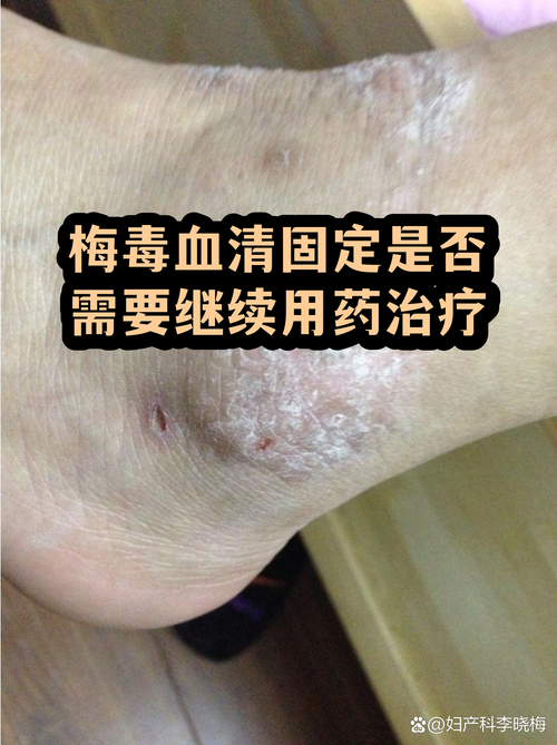 梅毒血清固定还要继续治疗吗