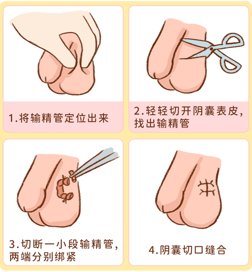 输精管结扎术前要做什么准备