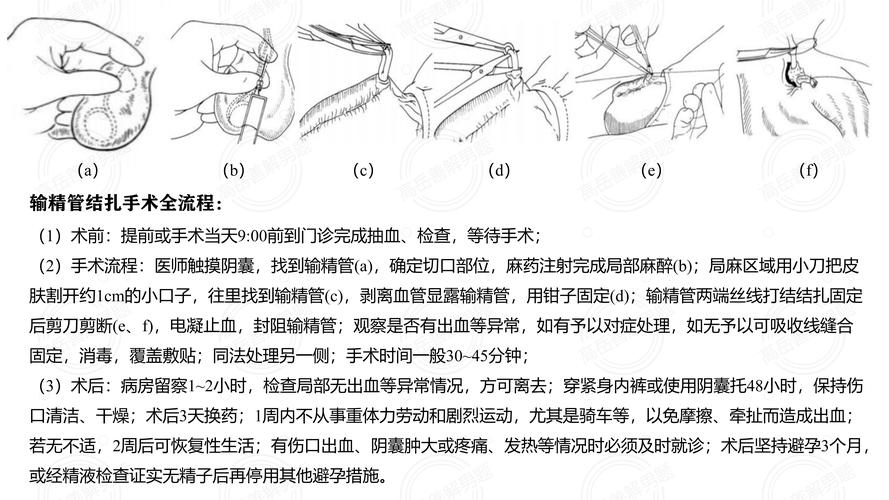 输精管结扎术前要做什么准备