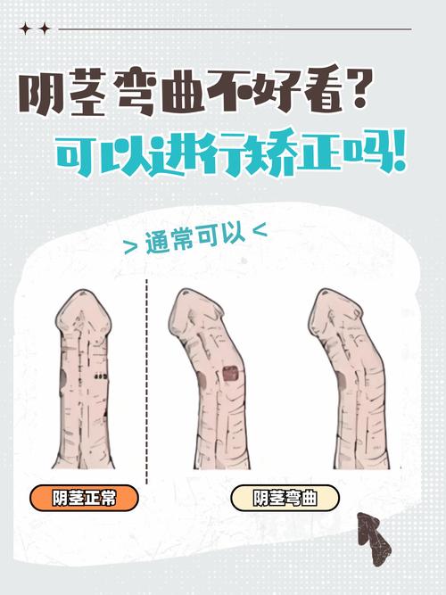 阴茎弯曲多少度需要就医-示意图