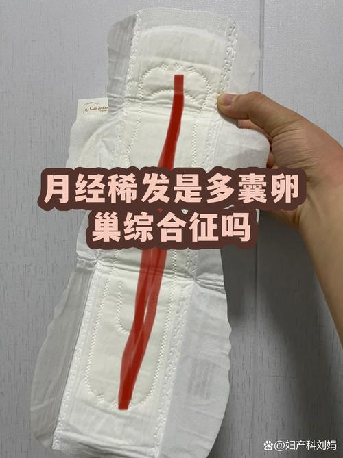 月经稀发就一定是多囊吗
