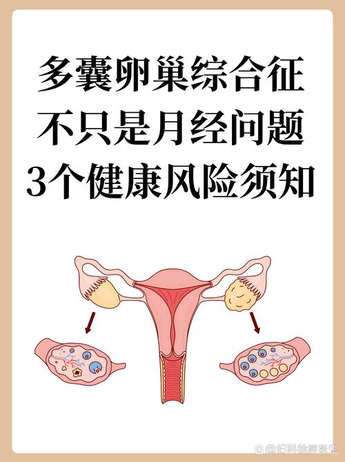 月经稀发就一定是多囊吗