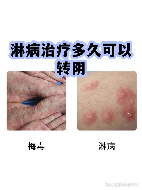 淋病规范治疗后怎么复查转阴-相关配图