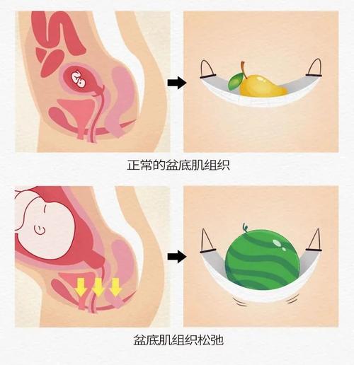 盆底肌高张和性交痛的关系