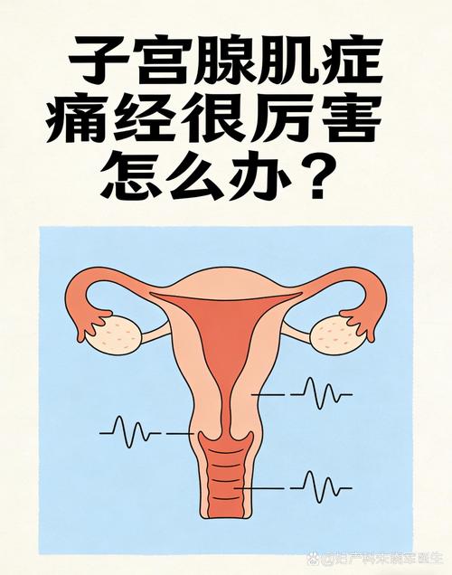 子宫腺肌症痛经怎么管理