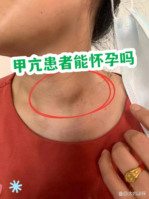 甲亢治疗期间能怀孕吗