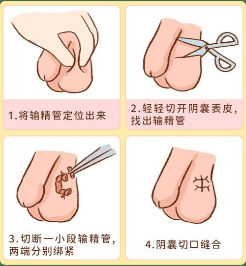 男性输精管结扎术有哪些方式