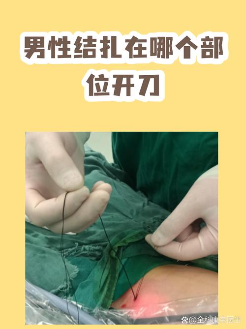男性输精管结扎术有哪些方式