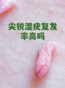 尖锐湿疣复发率高吗？皮肤科医生讲清复发的真相-两性知识丨两性健康--你想了解的我都知道