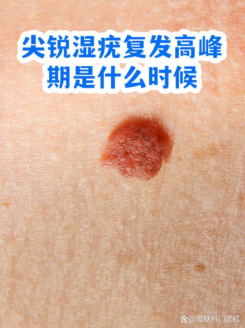 尖锐湿疣复发率高吗
