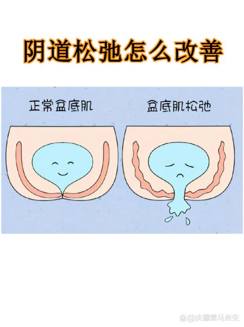盆底肌松弛和年龄有关吗-示意图
