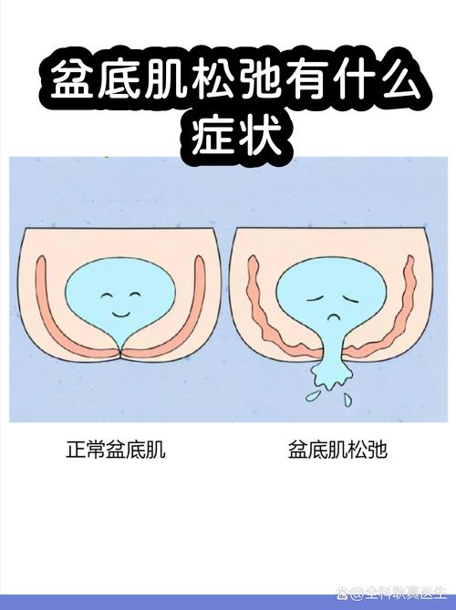 盆底肌松弛和年龄有关吗-相关配图