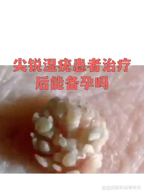 尖锐湿疣治疗期间能备孕吗