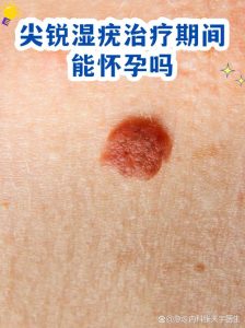 尖锐湿疣治疗期间能备孕吗？-两性知识丨两性健康--你想了解的我都知道