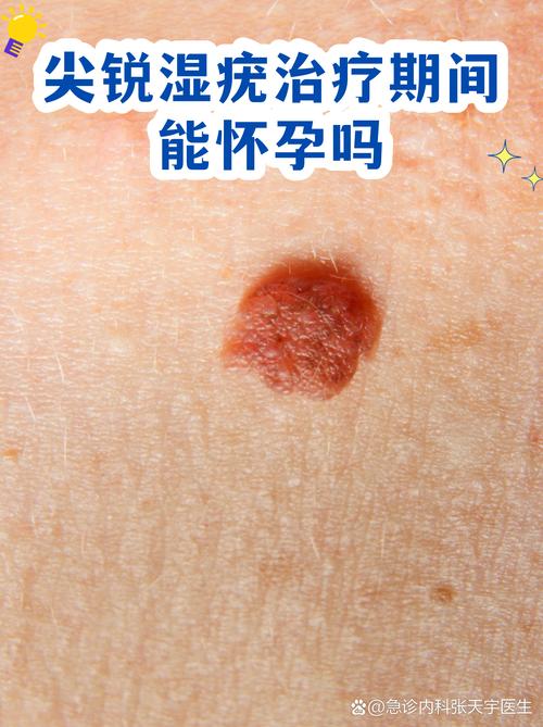 尖锐湿疣治疗期间能备孕吗