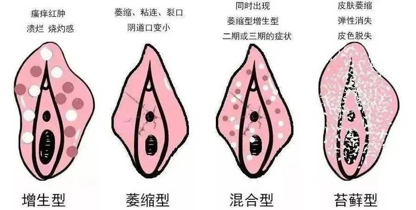 外阴反复瘙痒该怎么找原因-相关配图