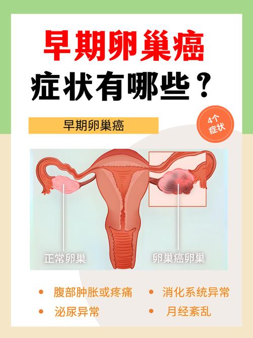 卵巢癌早期有哪些不典型表现