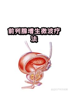 微创热疗适合哪些前列腺增生患者?-两性知识丨两性健康--你想了解的我都知道