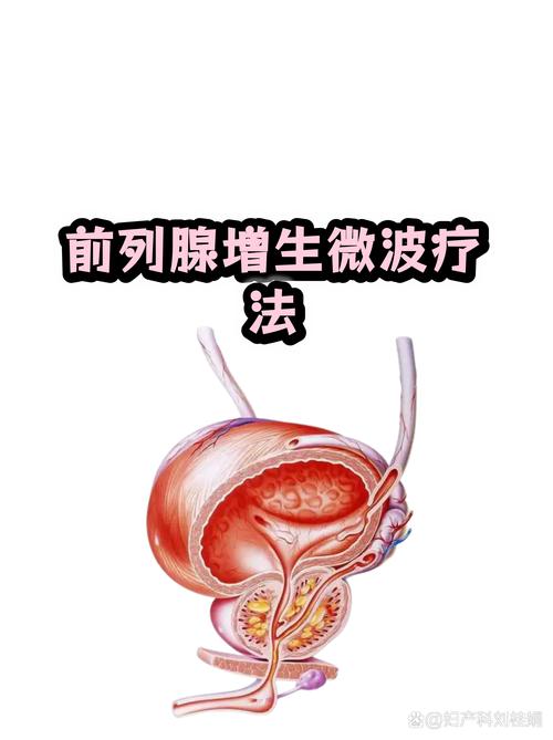 微创热疗适合哪些前列腺增生患者