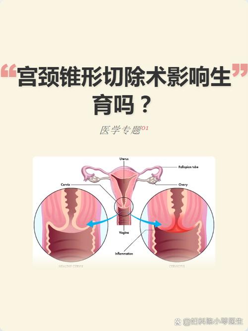 宫颈锥切会影响以后怀孕吗