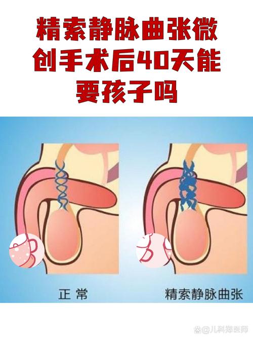 精索静脉手术后碎片率会下降吗