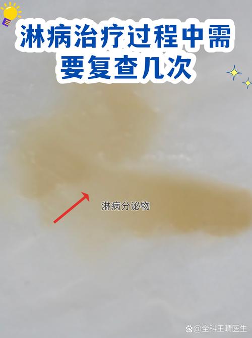 淋病规范治疗后还要复查几次-示意图