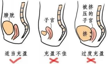 男性做前列腺B超要憋尿吗