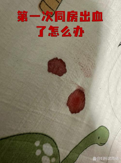 第一次同房一定出血吗