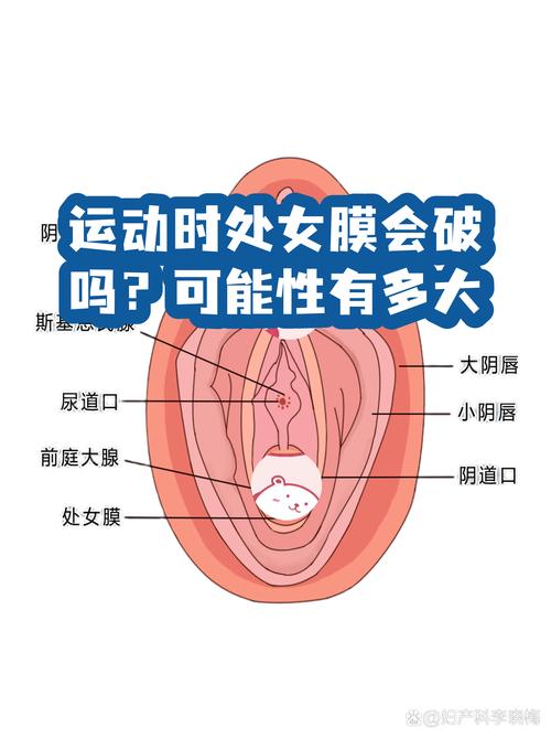 处女膜能通过运动破裂吗-相关配图