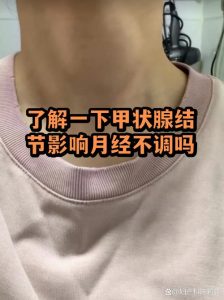 甲状腺结节会影响月经吗?一文看懂两者关系🩺-两性知识丨两性健康--你想了解的我都知道