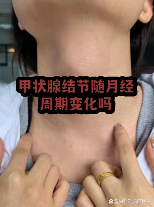 甲状腺结节会影响月经吗
