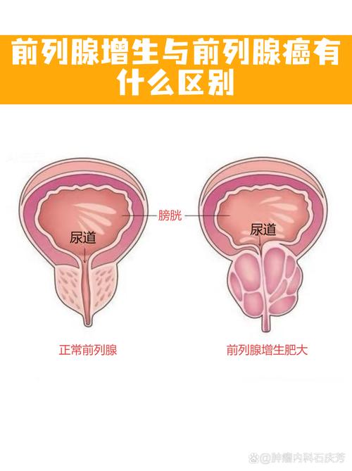 排精多少和前列腺癌的关系